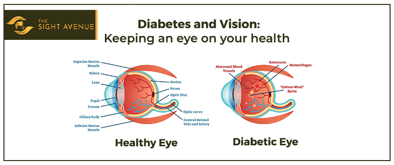 How Diabetes Can Affect Your Vision