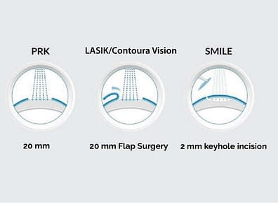 relex smile eye surgery